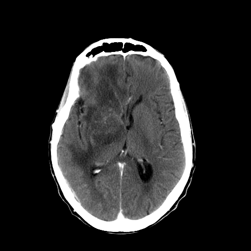 File:Acute necrotizing toxoplasma encephalitis (Radiopaedia 10683-11150 C+ arterial phase 16).jpg