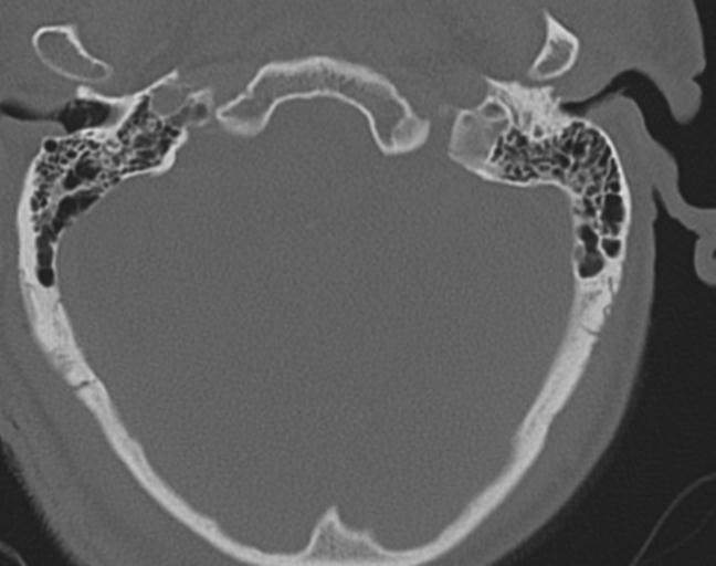 Acute on chronic subdural hematoma and thoracic vertebral injury in a multitrauma patient (Radiopaedia 31698-32619 Axial bone window 4).jpg