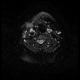 Acute otitis externa (Radiopaedia 57296-64236 Axial DWI 52).jpg