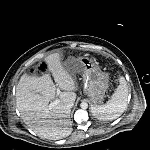 File:Acute pancreatic necrosis (Radiopaedia 13560-18501 Axial C+ portal venous phase 27).jpg