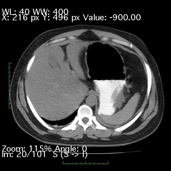 Acute pancreatitis (Radiopaedia 34043-35276 Axial non-contrast 20).jpg