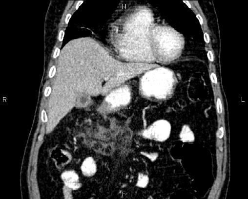 Acute pancreatitis (Radiopaedia 85146-100701 Coronal C+ portal venous phase 19).jpg