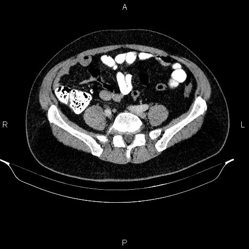Acute pancreatitis (Radiopaedia 85390-101010 Axial C+ portal venous phase 77).jpg
