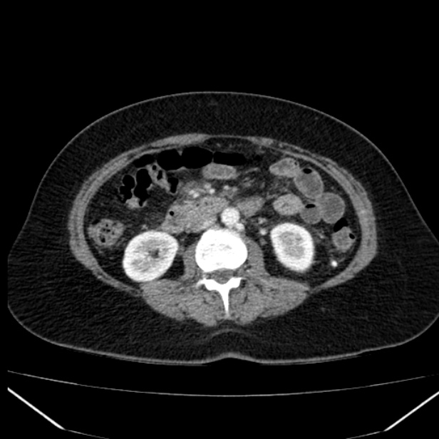 Acute pancreatitis - Balthazar C (Radiopaedia 26569-26714 Axial C+ arterial phase 44).jpg