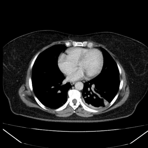 Acute pancreatitis - Balthazar C (Radiopaedia 26569-26714 Axial C+ portal venous phase 12).jpg