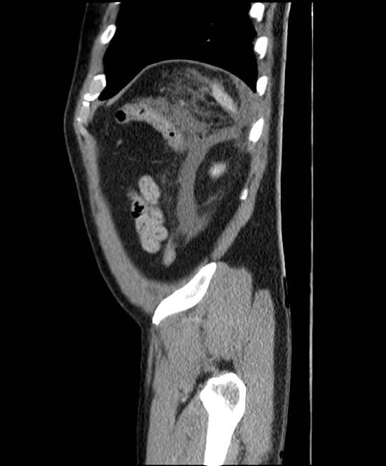 Acute pancreatitis - Balthazar E (Radiopaedia 23080-23110 Sagittal C+ portal venous phase 89).jpg