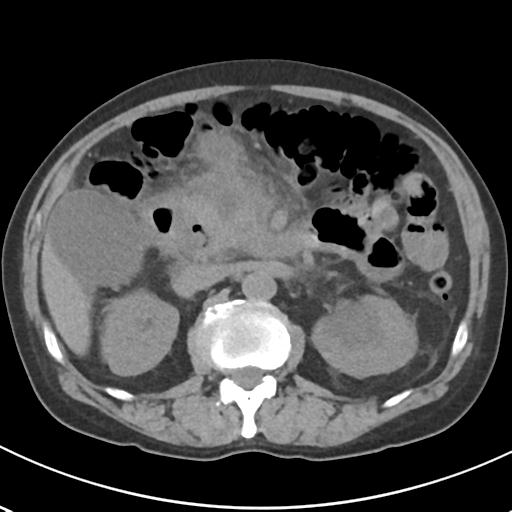 File:Acute pancreatitis and walled-off necrosis (Radiopaedia 29888-30404 Axial non-contrast 30).jpg