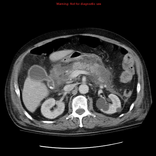 File:Acute pancreatitis with incidental pancreatic lipoma (Radiopaedia 10190-10730 Axial C+ portal venous phase 26).jpg