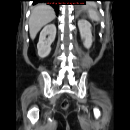 Acute pancreatitis with incidental pancreatic lipoma (Radiopaedia 10190-10730 Coronal C+ portal venous phase 57).jpg