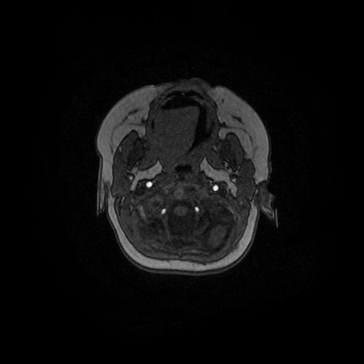 Acute phase of hemiconvulsion-hemiplegia epilepsy syndrome (Radiopaedia 29309-29745 Axial TOF angiography 156).jpg