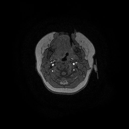 Acute phase of hemiconvulsion-hemiplegia epilepsy syndrome (Radiopaedia 29309-29745 Axial TOF angiography 172).jpg