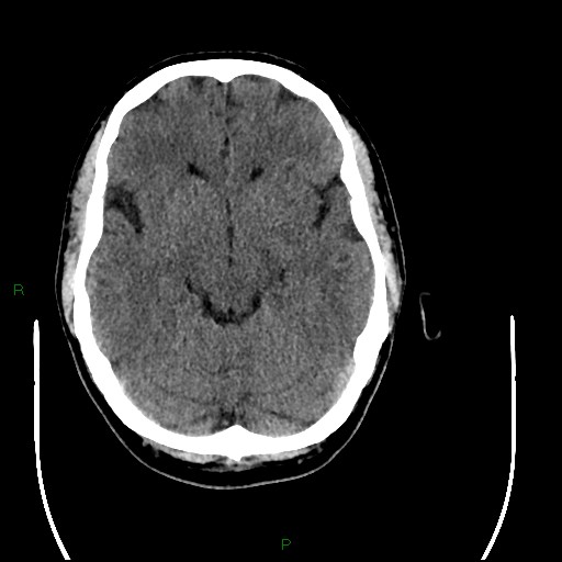 Acute posterior cerebral artery territory infarct (Radiopaedia 79329-92393 Axial non-contrast 43).jpg