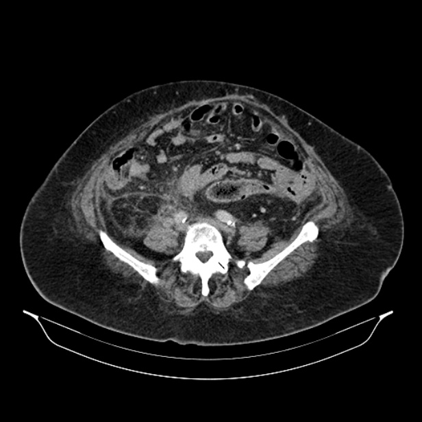 Acute pyelonephritis (Radiopaedia 25657-25837 Axial renal parenchymal phase 54).jpg