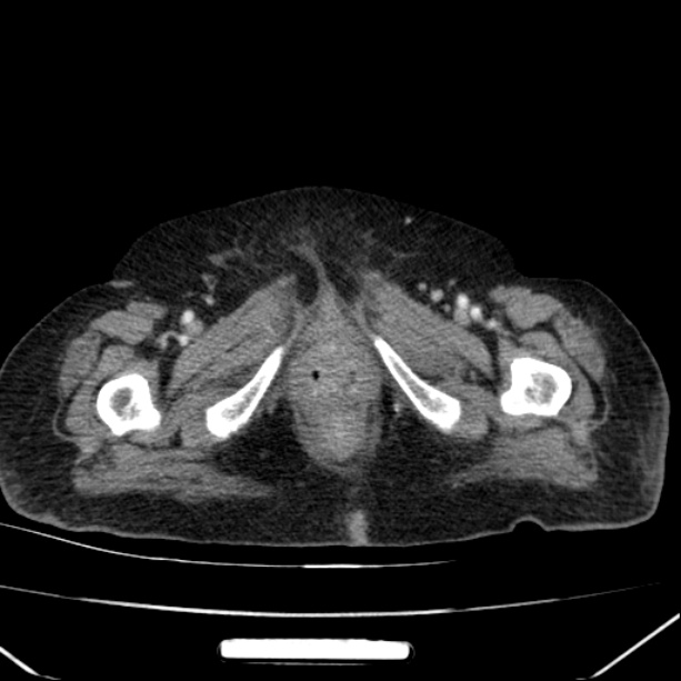 Acute pyelonephritis (Radiopaedia 26584-26729 Axial renal cortical phase 79).jpg