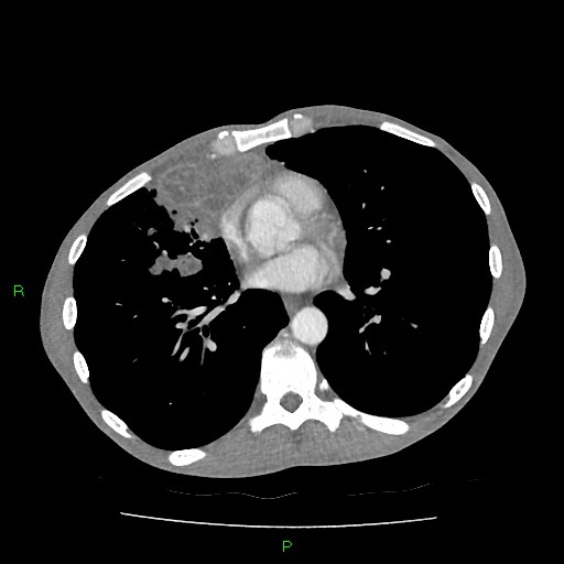 File:Acute right lung abscess (Radiopaedia 34806-36258 Axial C+ arterial phase 114).jpg