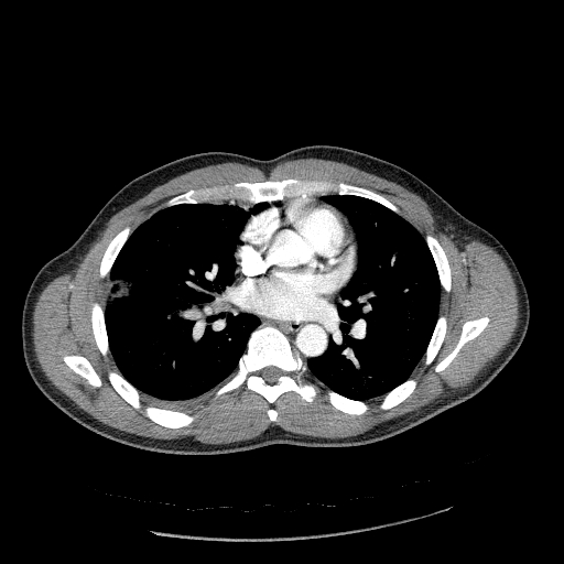 Acute segmental pulmonary emboli and pulmonary infarction (Radiopaedia 62264-70444 Axial C+ CTPA 61).jpg