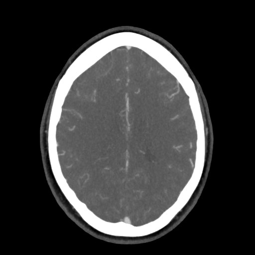 Acute subarachnoid hemorrhage and accessory anterior cerebral artery (Radiopaedia 69231-79009 D 47).jpg