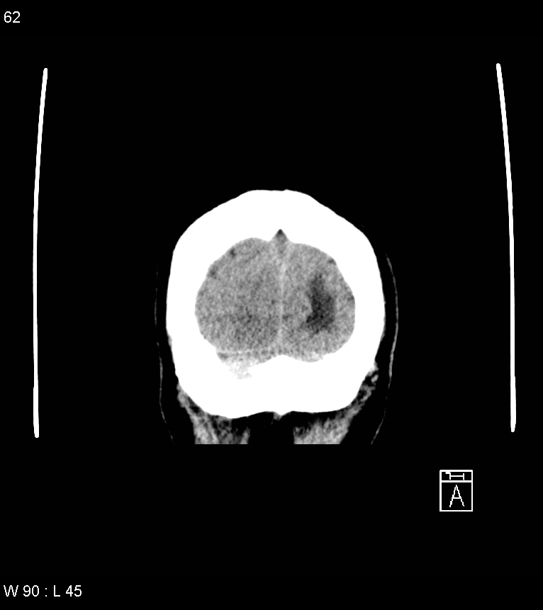 Acute subdural hematoma with myelofibrosis (Radiopaedia 52582-58494 Coronal non-contrast 53).jpg
