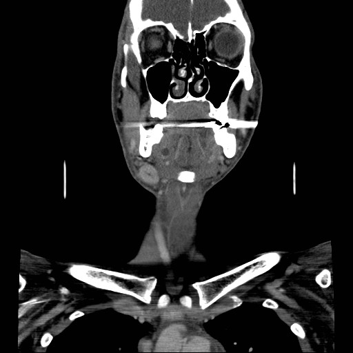 File:Acute submandibular sialadenitis secondary to ductal stone (Radiopaedia 27999-28267 D 19).jpg