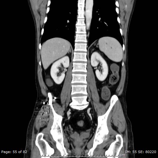 Acute superior mesenteric artery occlusion (Radiopaedia 43636-47060 Coronal C+ portal venous phase 40).jpg