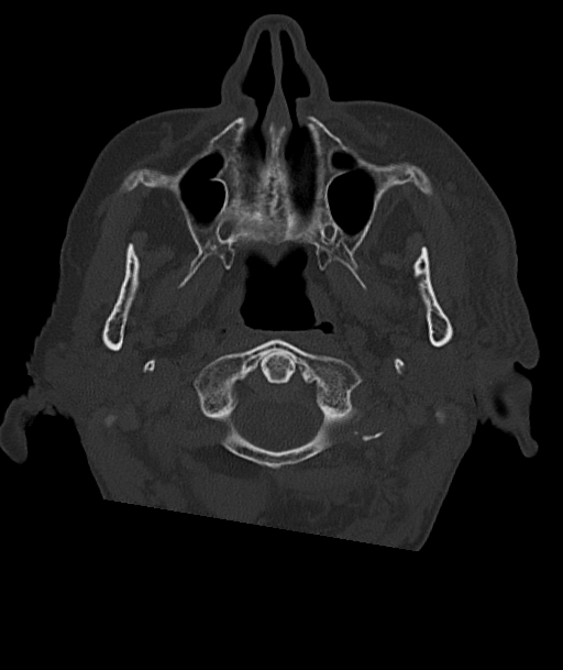 Acute traumatic subdural hematoma (Radiopaedia 82921-97257 Axial bone window 101).jpg