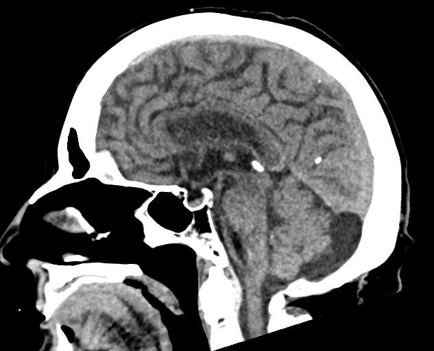Acute traumatic subdural hematoma (Radiopaedia 82921-97257 Sagittal non-contrast 39).jpg