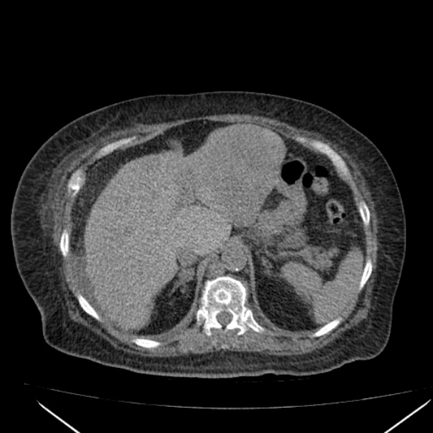 Acute tubular necrosis (Radiopaedia 28077-28334 Axial non-contrast 19).jpg