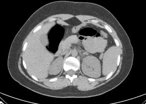 Acute unilateral nonhemorrhagic adrenal infarction (Radiopaedia 67560-76957 Axial non-contrast 42).jpg