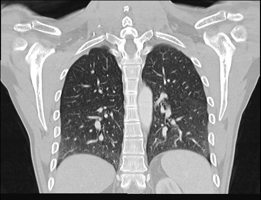 File:Addison disease (Radiopaedia 49318-54412 Coronal lung window 11).jpg