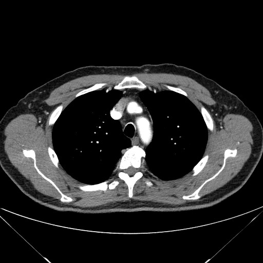 File:Adenocarcinoma of the lung (Radiopaedia 59871-67325 Axial C+ arterial phase 23).jpg
