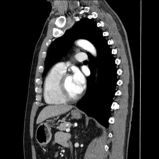 Adenocarcinoma of the lung (Radiopaedia 59871-67325 Sagittal C+ arterial phase 62).jpg