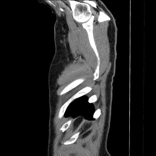 Adenocarcinoma of the lung (Radiopaedia 59871-67325 Sagittal C+ arterial phase 99).jpg