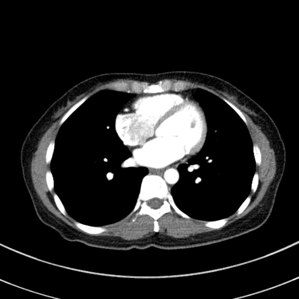 Adenocystic carcinoma of the trachea (Radiopaedia 47677-52525 Axial C+ arterial phase 59).jpg