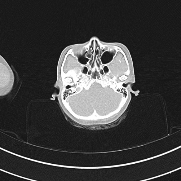 Adenocystic carcinoma of the trachea (Radiopaedia 47677-52525 Axial lung window 2).jpg