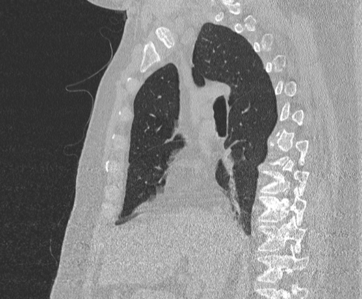 Adenoid cystic carcinoma of the trachea (Radiopaedia 49042-54137 Sagittal lung window 203).jpg