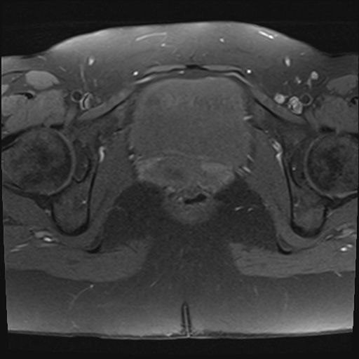 File:Adenomyosis and endometriotic cysts (Radiopaedia 82300-96367 Axial T1 fat sat 1).jpg