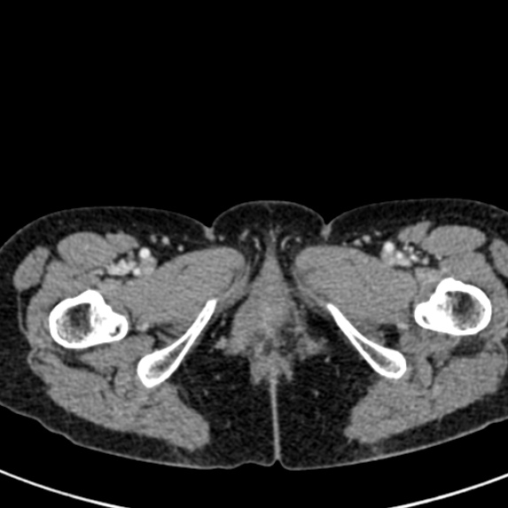 Adhesional small bowel obstruction (Radiopaedia 48397-53305 Axial C+ portal venous phase 102).jpg