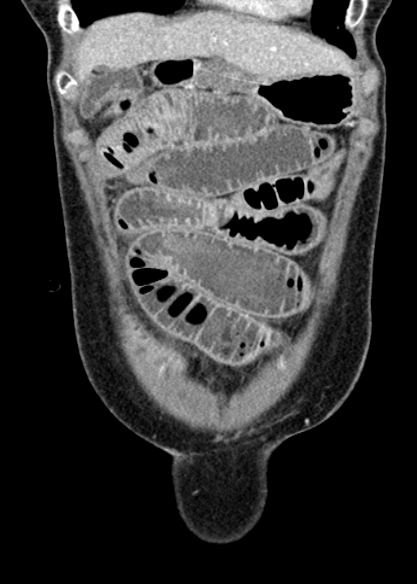 Adhesional small bowel obstruction (Radiopaedia 48397-53305 Coronal C+ portal venous phase 68).jpg