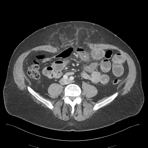 Adhesions within abdominal wall hernia (Radiopaedia 58283-65394 Axial C+ portal venous phase 52).png