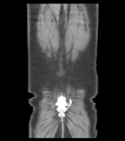 Adhesions within abdominal wall hernia (Radiopaedia 58283-65394 Coronal C+ portal venous phase 64).png