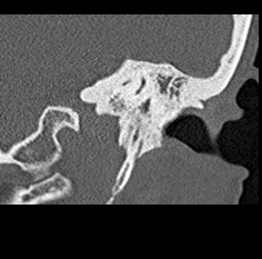 File:Adhesive chronic otitis media (Radiopaedia 14270-14148 Coronal bone window - left 20).jpg