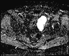 File:Adnexal multilocular cyst (O-RADS US 3. O-RADS MRI 3) (Radiopaedia 87426-103754 Axial 153).jpeg