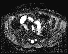 File:Adnexal multilocular cyst (O-RADS US 3. O-RADS MRI 3) (Radiopaedia 87426-103754 Axial 173).jpeg