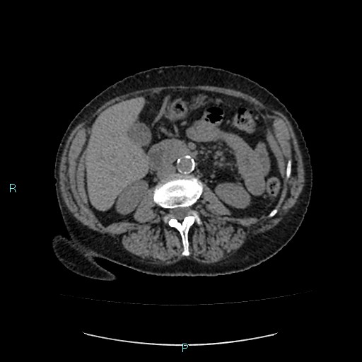 File:Adrenal collision tumor (ACT) (Radiopaedia 48462-53379 Axial non-contrast 28).jpg