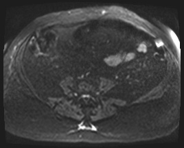 Adrenal cortical carcinoma (Radiopaedia 64017-72770 Axial DWI 85).jpg