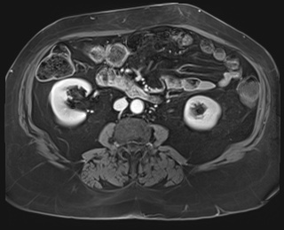 File:Adrenal cortical carcinoma (Radiopaedia 64017-72770 J 54).jpg