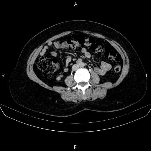 Adrenal cortical carcinoma (Radiopaedia 84882-100379 Axial C+ delayed 48).jpg