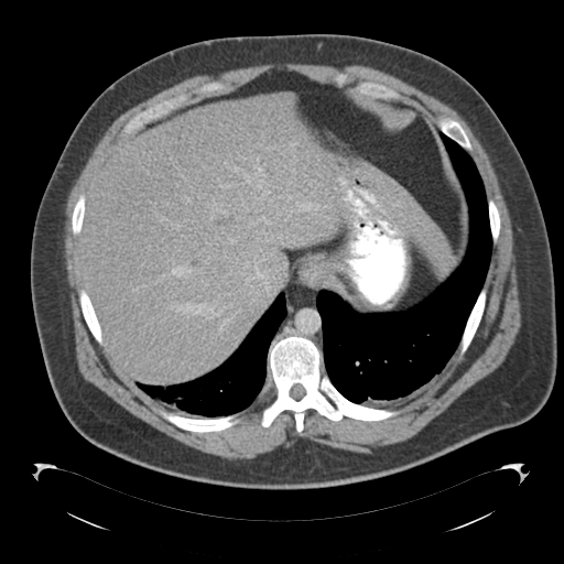 Adrenal cyst (Radiopaedia 45625-49776 Axial C+ portal venous phase 18).png