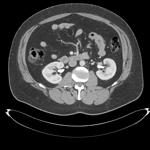 File:Adrenal cyst (Radiopaedia 45625-49778 AXIAL THICK 60 sec 42).png