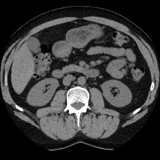 Adrenal gland trauma (Radiopaedia 81351-95079 Axial non-contrast 49).jpg